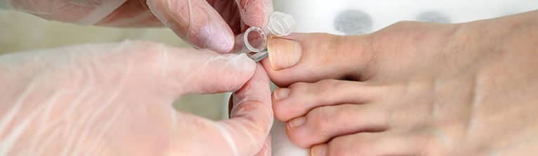 Nagelpilz Diagnose Nagelprobe entnommen durch Dermatologen