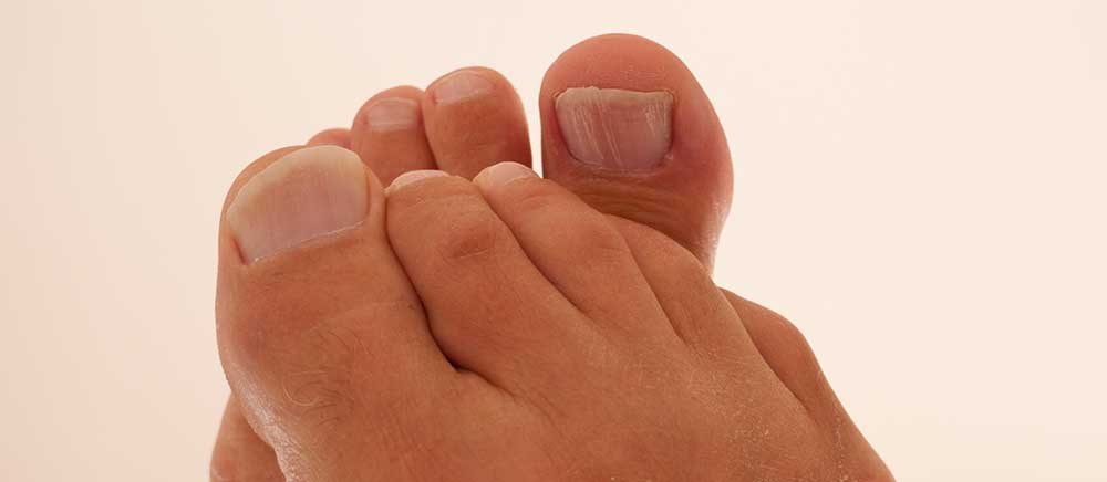 Nagelpilz auch Onychomykose oder Tinea unguium genannt