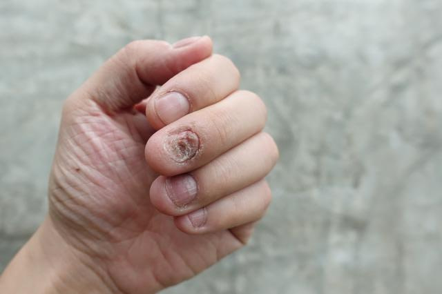 Fingernagelpilz linke Hand