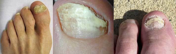Welche Nagelpilz Symptome zehennagel