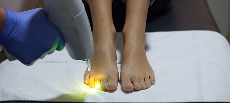 Laser gegen Nagelpilz Behandlung