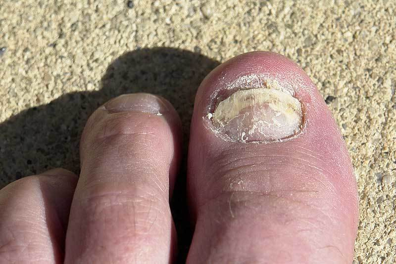 Fußnagelpilz Bild 6